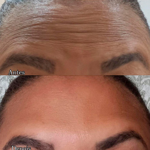 Resultado de tratamento 1