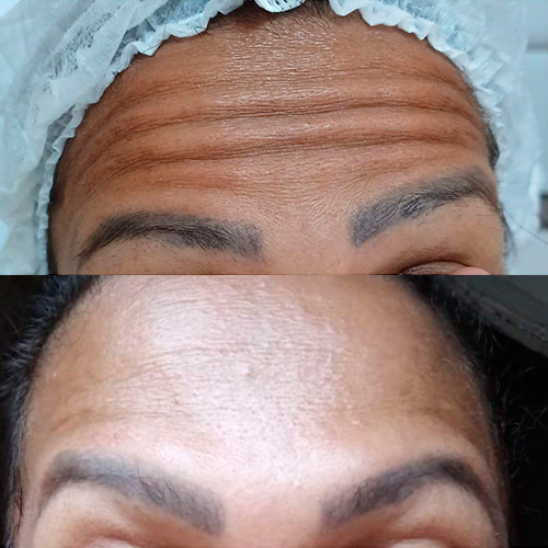 Resultado de tratamento 2