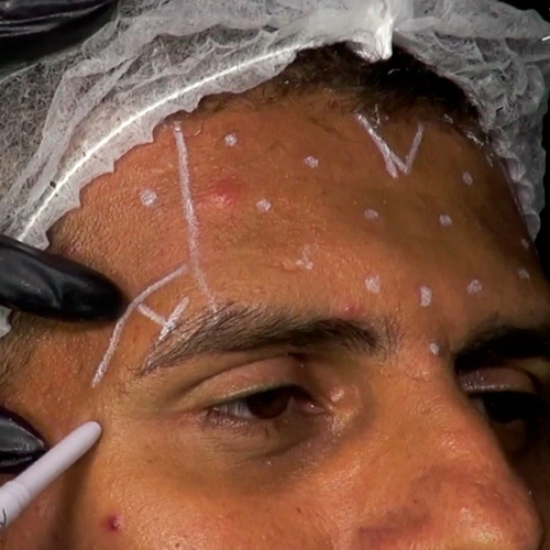 Marcando os pontos corretos de aplicação